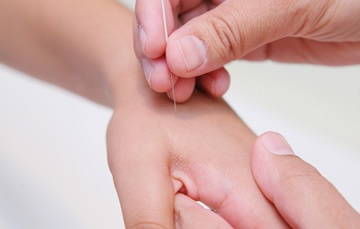 acupuncture-1