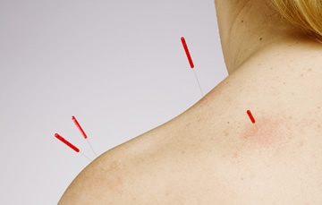 acupuncture-3