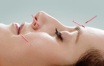acupuncture-4
