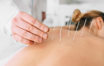 acupuncture